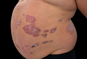 ¿La psoriasis tiene cura? Tratamientos disponibles
