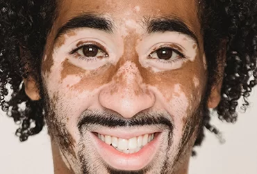 Tudo o que Precisas Saber sobre o Vitiligo: Causas, Sintomas e Tratamentos