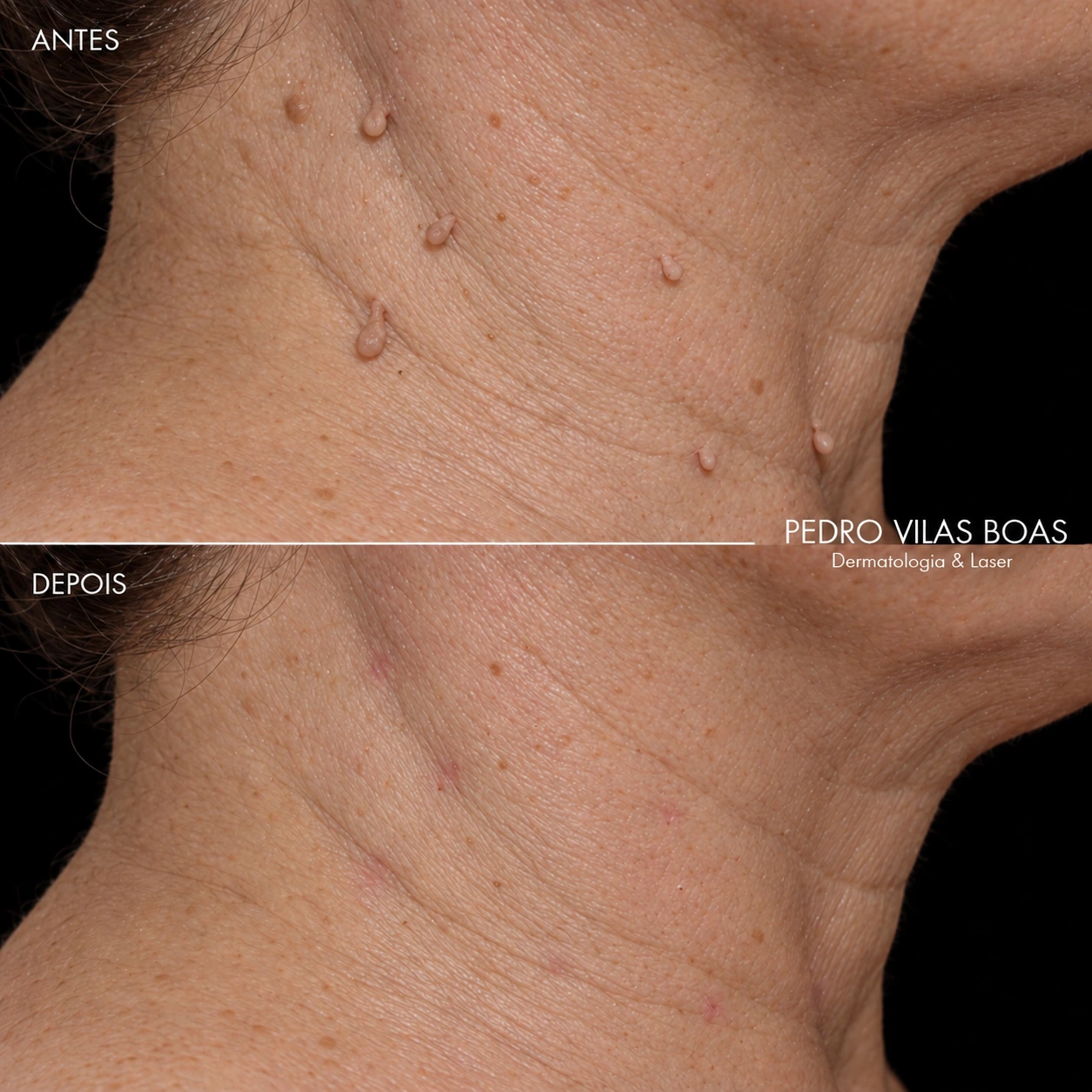 Comparación del cuello antes y después de eliminar acrocordones